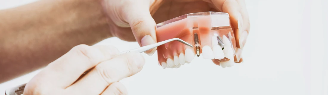 FC – Implant Restoration in Hacienda Heights CA